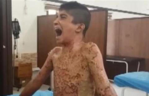  أردوغان يحرق أطفال سورية.. والأمم المتحدة تحقق
