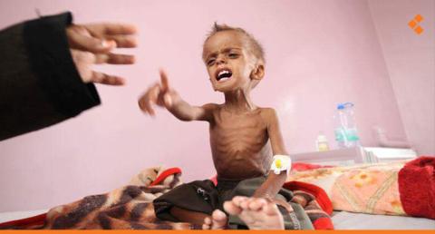 2 مليون و900 ألف طفل يمني دون الخامسة يعانون من سوء التغذية