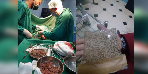  400 غرام من الحصيات من مثانة مريض يبلغ من العمر 94 عاماً في حلب