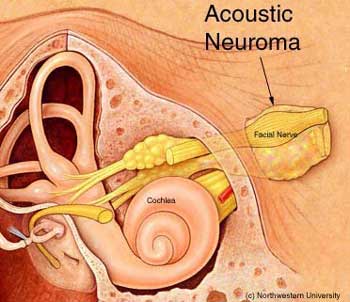 نقص حمض الفوليك وهو نوع من الفيتامين (ب) مرتبط بشكل كبير بفقدان السمع