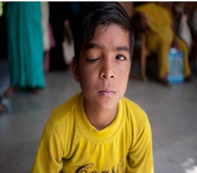 طفل هندي مصاب نتيجة اختبارات الدواء