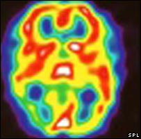 صورة للدماغ أثناء حدوث نوبة صداع نصفي